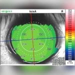 Corneal Topographer 8