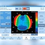 Corneal Topographer 3