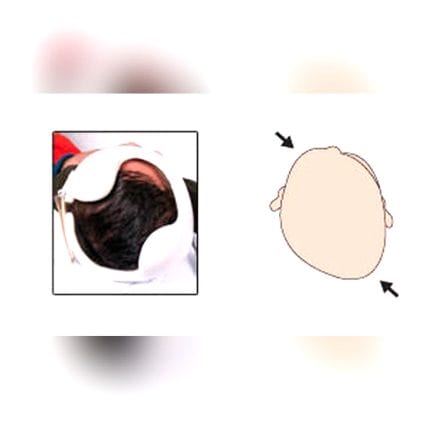 Cranial Orthosis 1