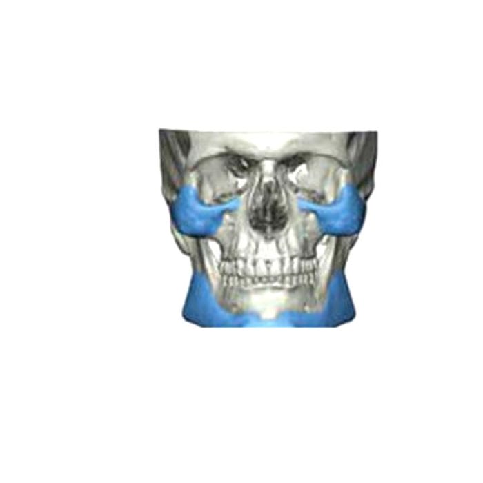 Custom-Made Cranial Implant 4