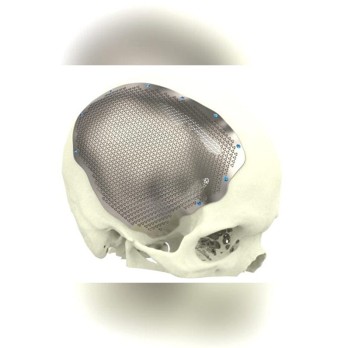 Custom-Made Cranial Implant 4