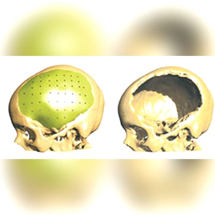 Custom-Made Cranial Implant