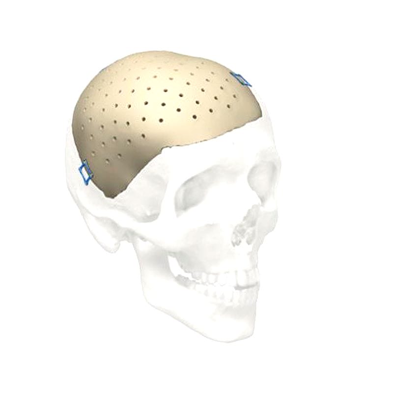 Custom-Made Cranial Implant