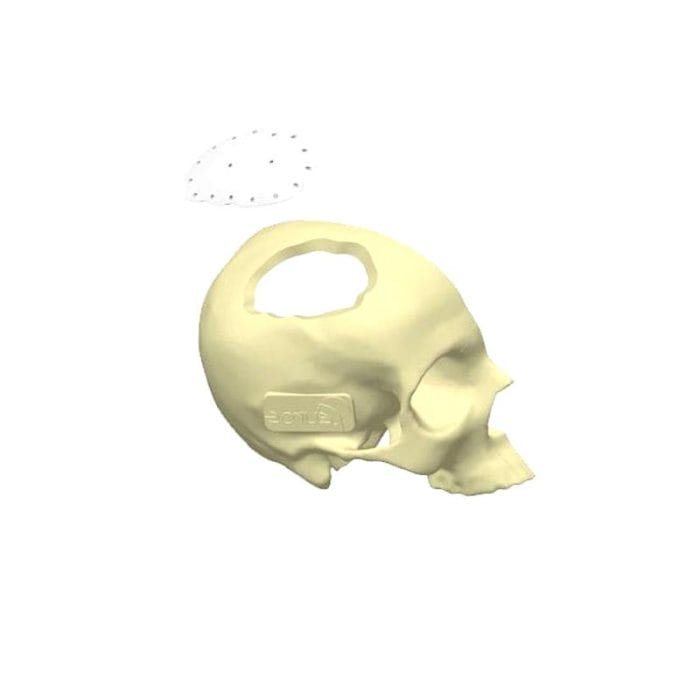 Custom-Made Cranial Implant