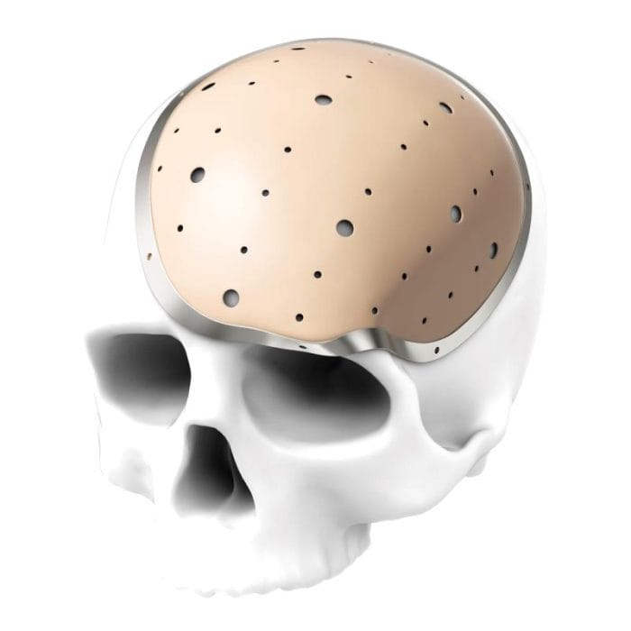 Custom-Made Cranial Implant