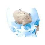 Custom-Made Cranial Implant 1