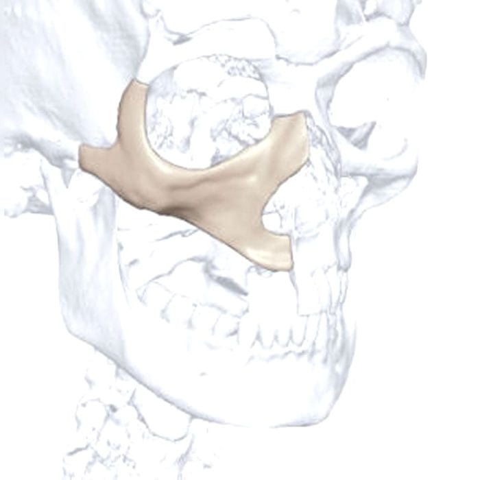 Custom-Made Cranial Implant 2