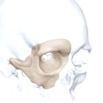 Custom-Made Cranial Implant 3