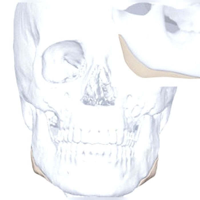 Custom-Made Cranial Implant 5