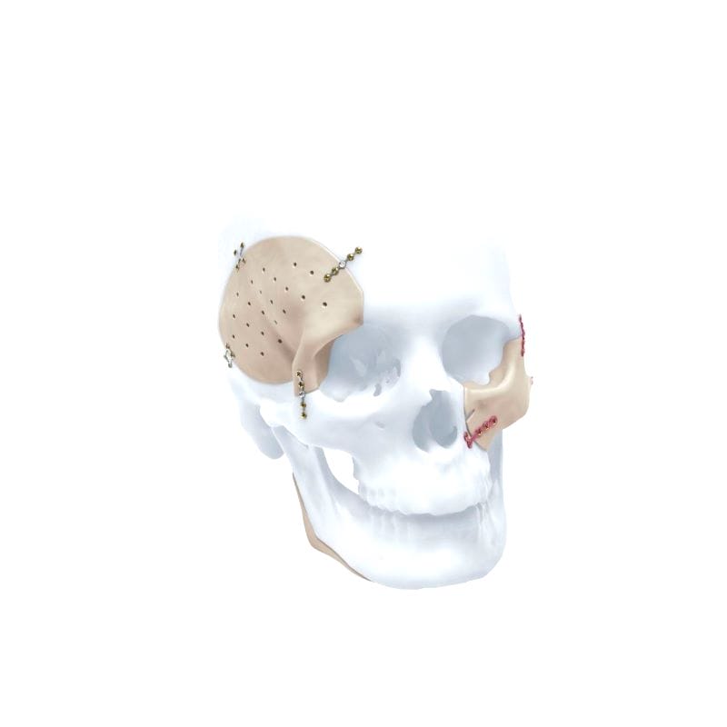 Custom-Made Cranial Implant