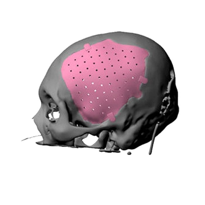 Custom-Made Cranial Implant 1