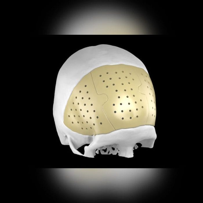 Custom-Made Cranial Implant 2