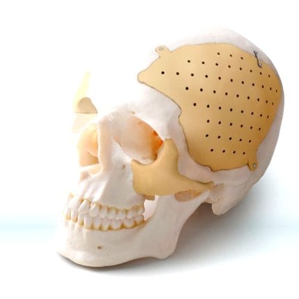 Custom-Made Cranial Implant