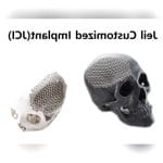 Custom-Made Cranial Implant 2