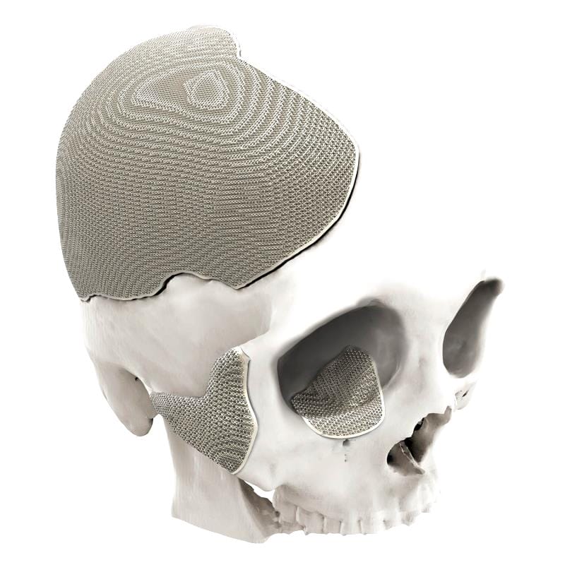 Custom-Made Cranial Implant