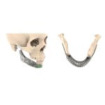 Custom-Made Mandibular Implant 1