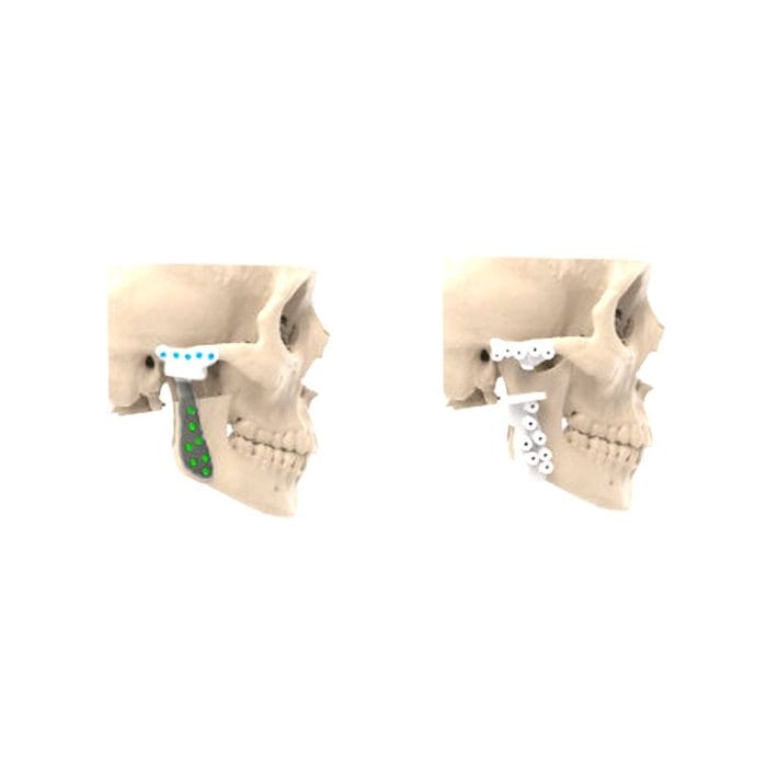 Custom-Made Mandibular Implant 2