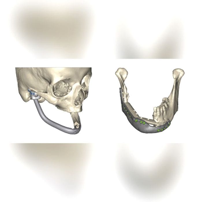 Custom-Made Mandibular Implant 4