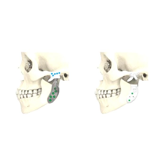 Custom-Made Mandibular Implant