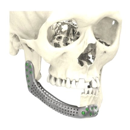 Custom-Made Mandibular Implant 1