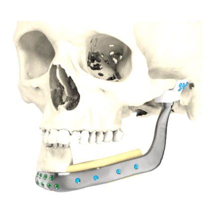 Custom-Made Mandibular Implant