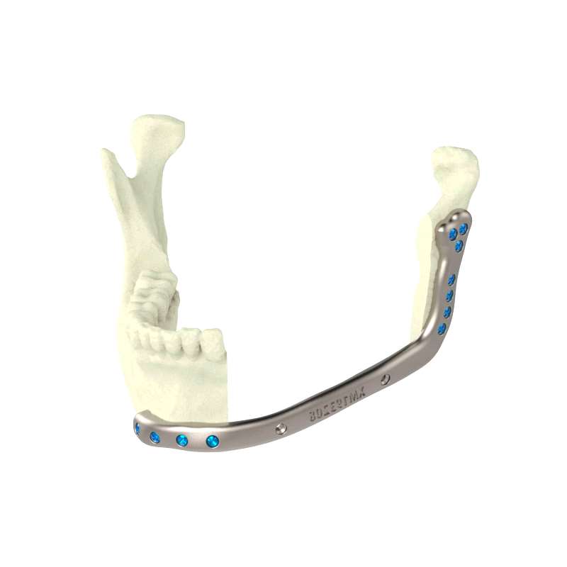 Custom-Made Mandibular Implant