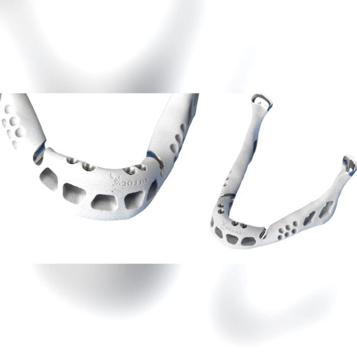 Custom-Made Mandibular Implant 2