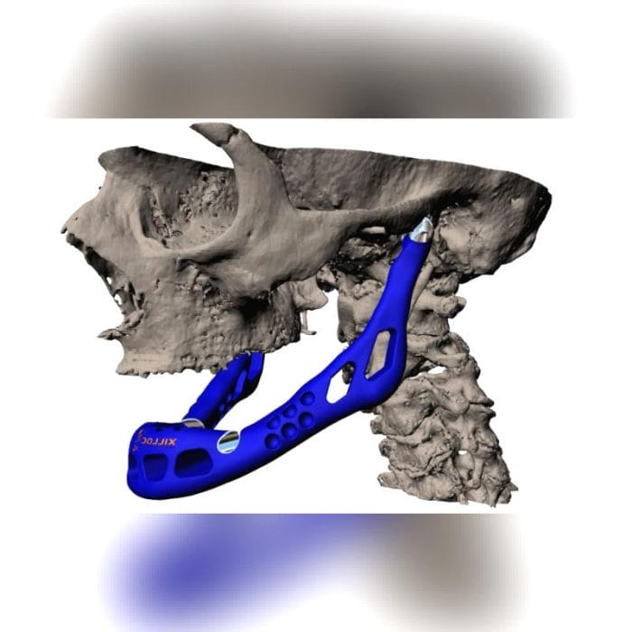 Custom-Made Mandibular Implant 4