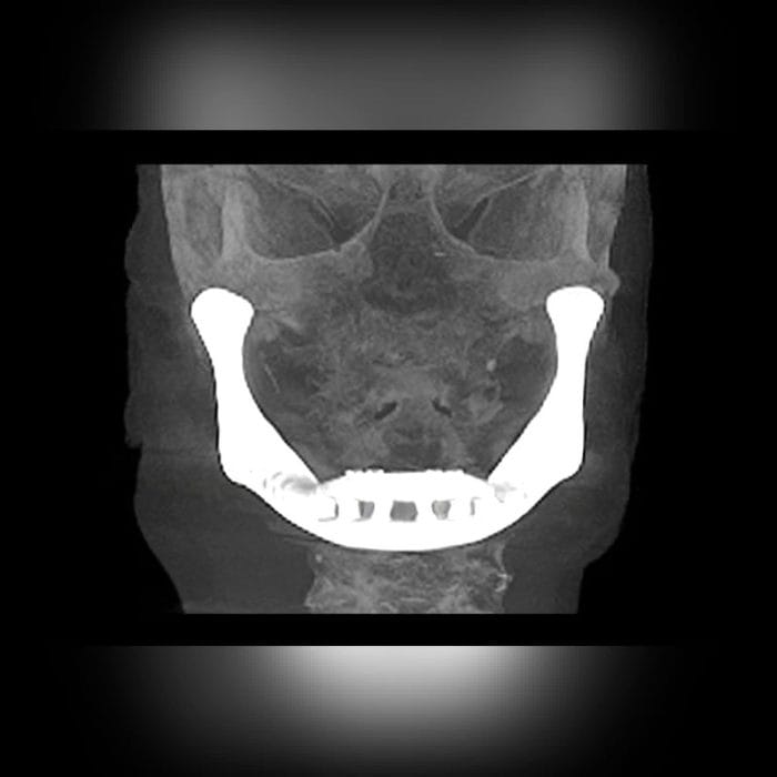 Custom-Made Mandibular Implant 6