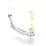 Custom-Made Mandibular Implant 8