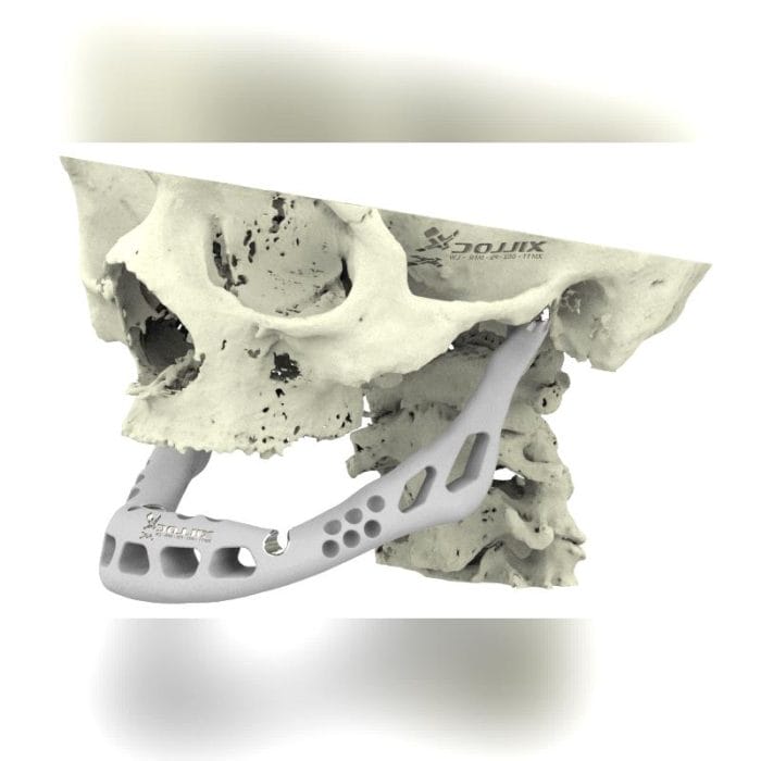 Custom-Made Mandibular Implant 9