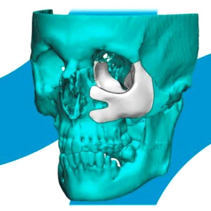 Custom-Made Periorbital Implant