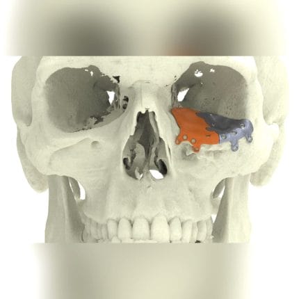 Custom-Made Periorbital Implant 1