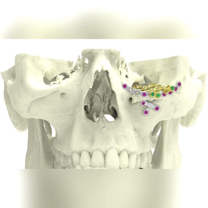 Custom-Made Periorbital Implant 2