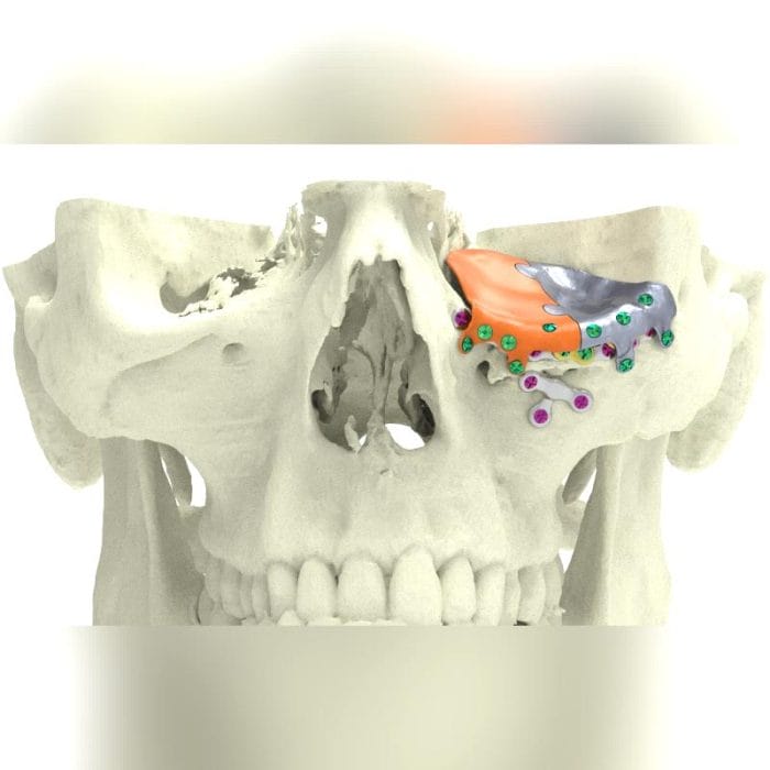 Custom-Made Periorbital Implant 3