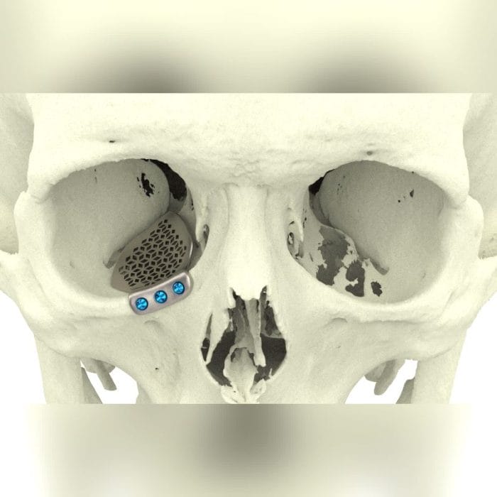 Custom-Made Periorbital Implant 4