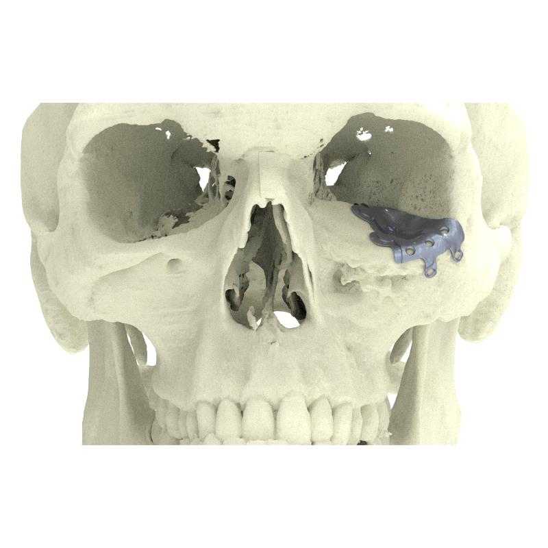 Custom-Made Periorbital Implant