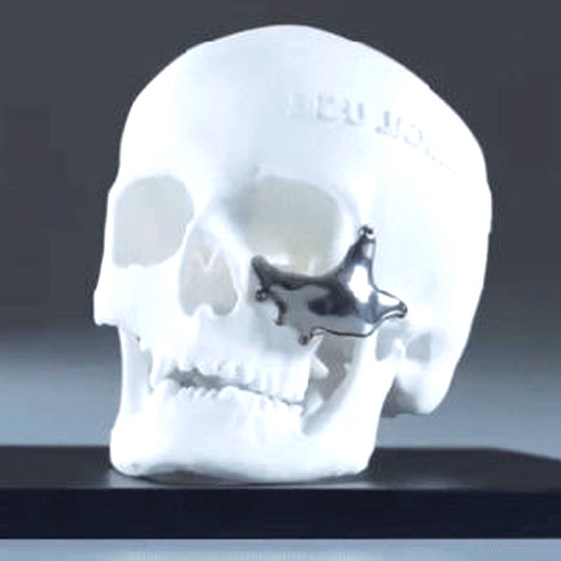 Custom-Made Periorbital Implant