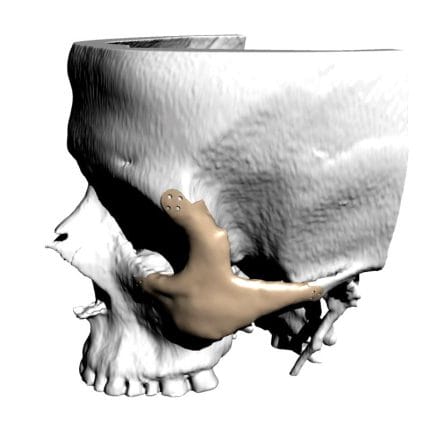 Custom-Made Periorbital Implant