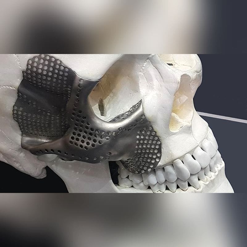 Custom-Made Periorbital Implant