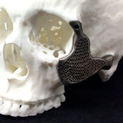 Custom-Made Periorbital Implant