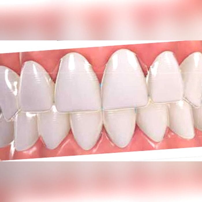 Dental Aligner 2