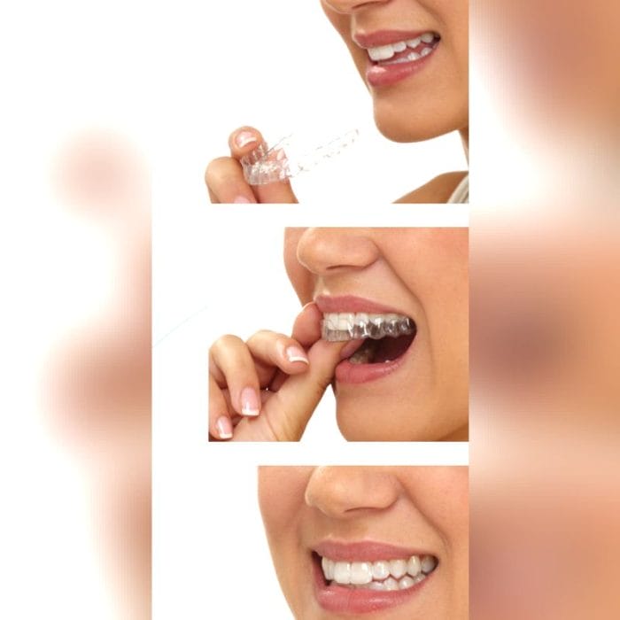 Dental Aligner 4