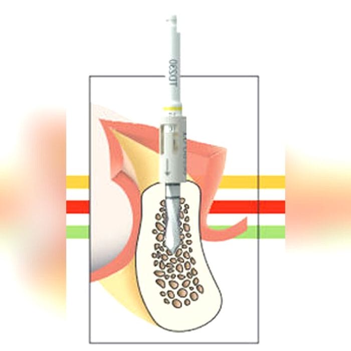 Dental Implantology Drill Bit 2