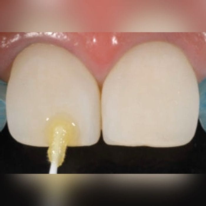 Dental Veneer Dental Cement 2