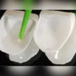 Dental Veneer Dental Cement 4