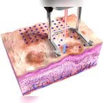 Dermatology Laser 5