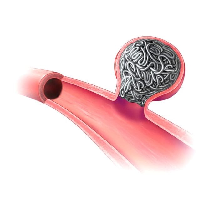 Detachable Embolization Coil