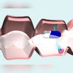 Digestive Endoscopy Capsule 4