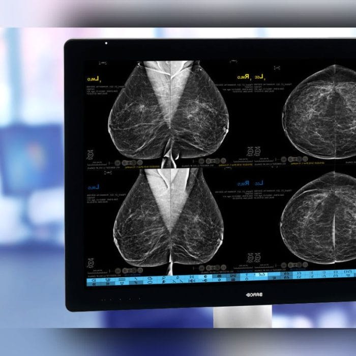 Digital Breast Tomosynthesis Mammography Unit 5